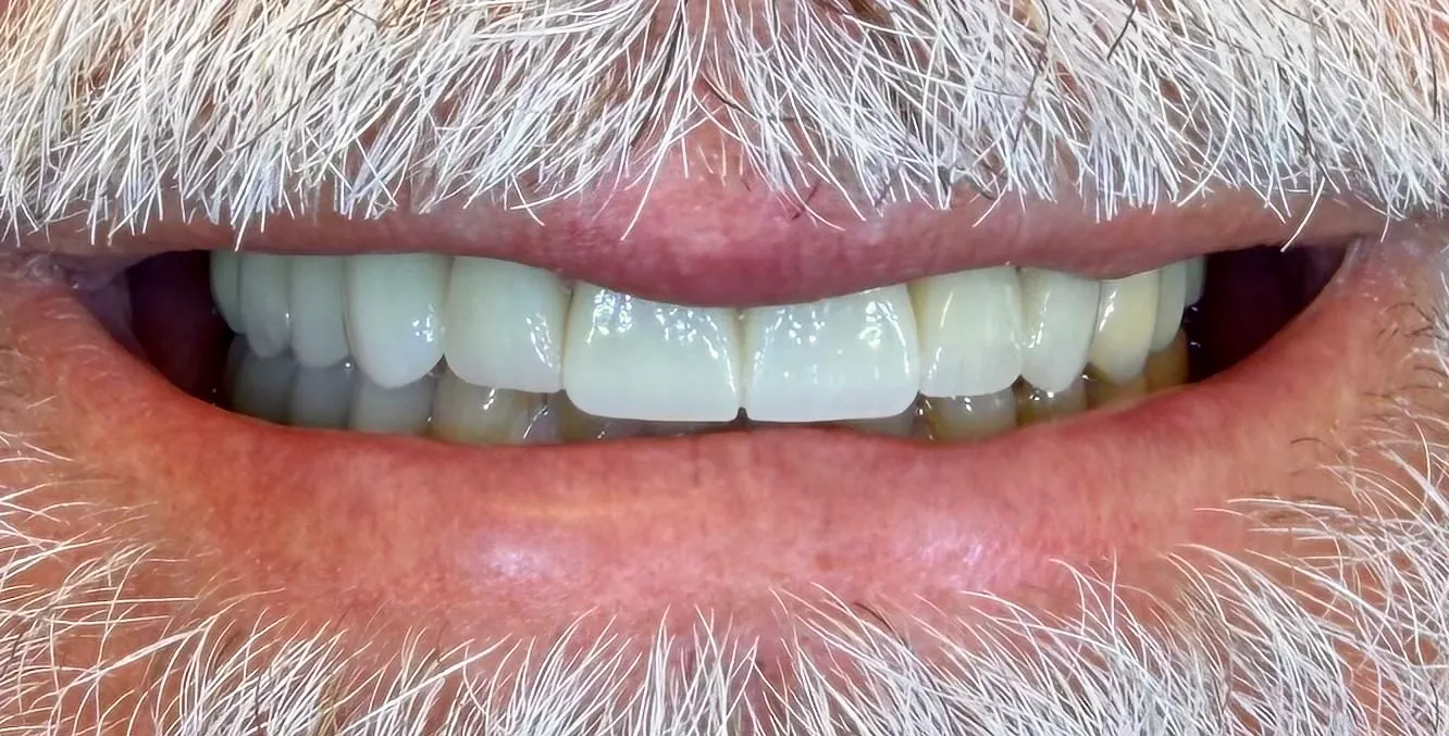 Smile Gallery | Legacy Dental | Before & After Pictures